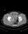expanding haematoma with contrast